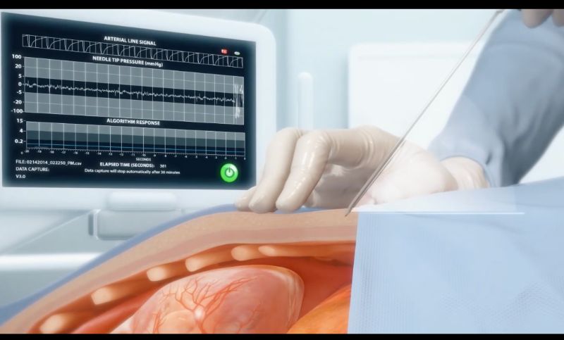 【三维医疗动画】心外膜系统医疗产品流程三维动画设计制作